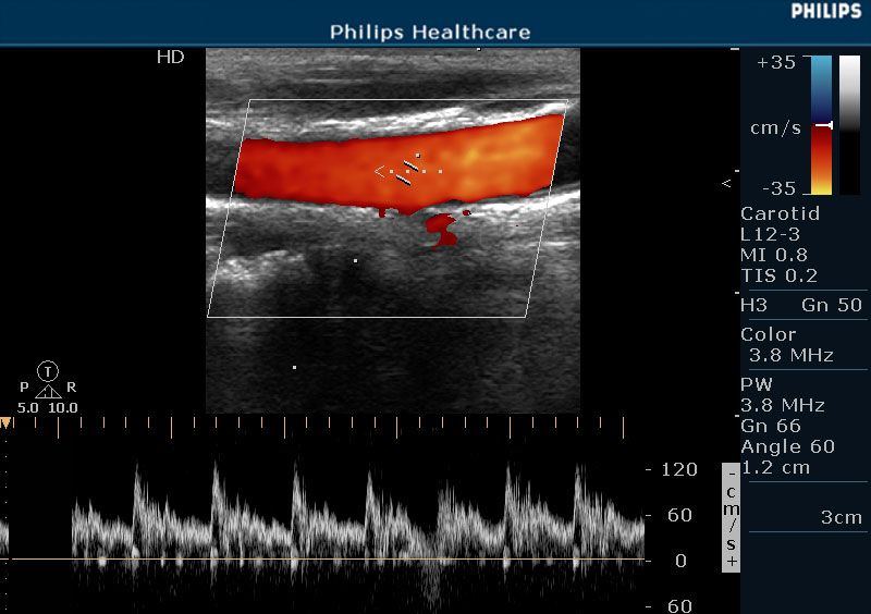Philips HD5