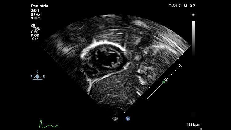 Philips EPIQ CVx