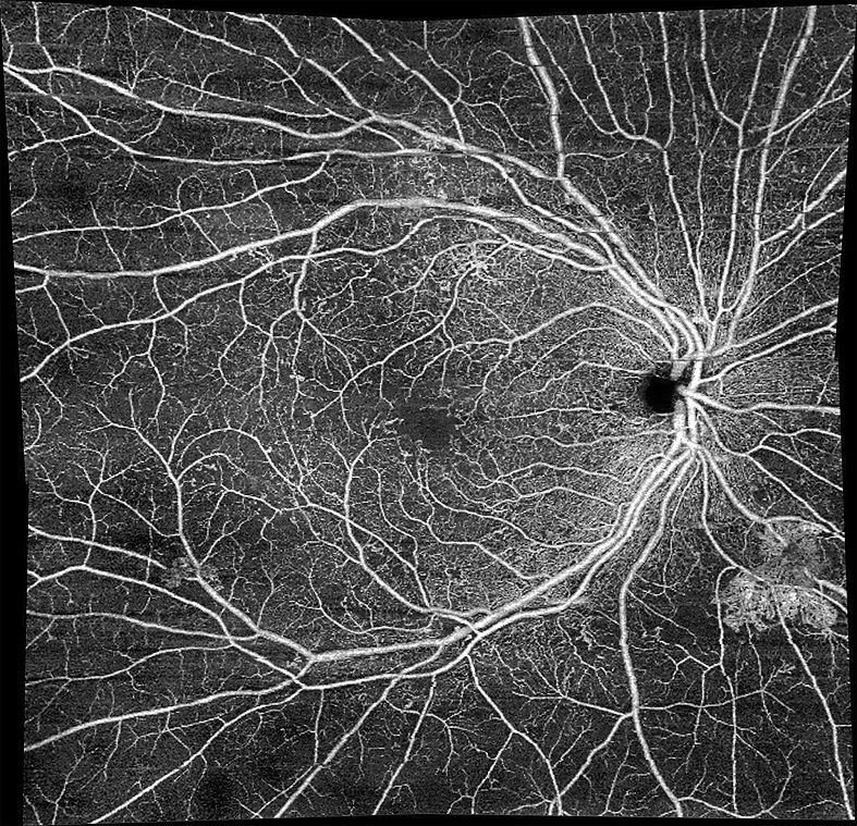 Carl Zeiss OCT AngioPlex