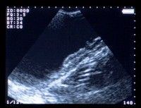Acuvista VT98m