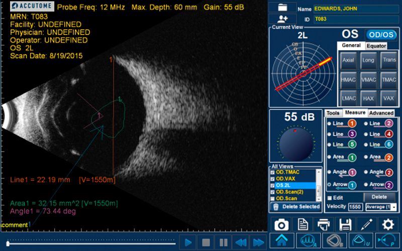 Accutome by Keeler B-scan Plus
