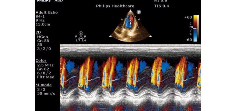 Philips ClearVue 850