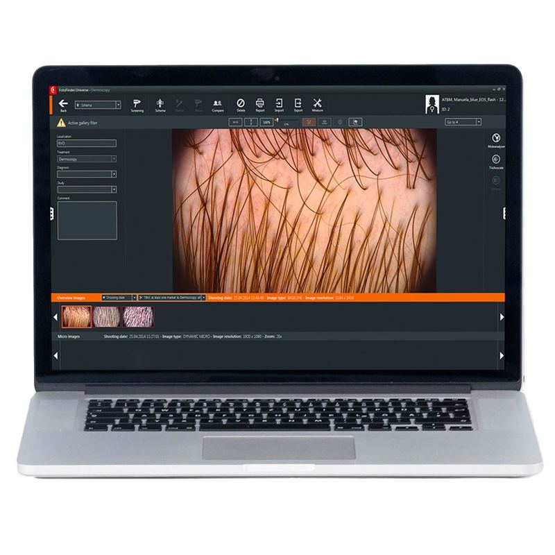 FotoFinder Trichovision