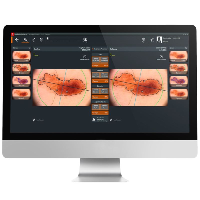 FotoFinder Moleanalyser Pro