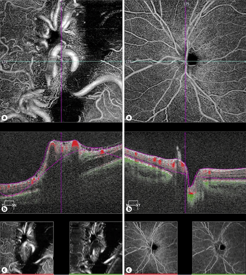 Carl Zeiss OCT AngioPlex
