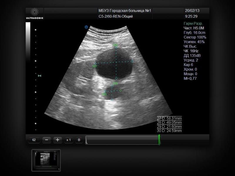 UltraSonix SonixMDP