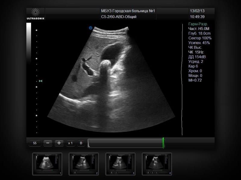 UltraSonix SonixMDP