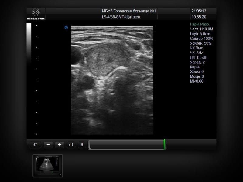 UltraSonix SonixMDP
