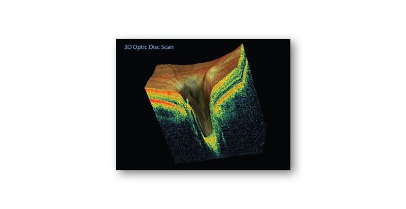 Optovue iScan