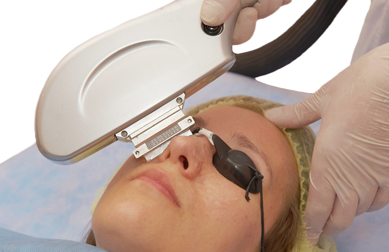 Beijing Toplaser Technology Soft Light W Skin
