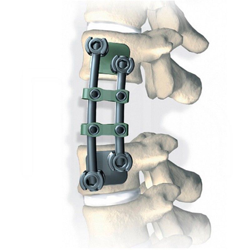 Stryker XIA anterior