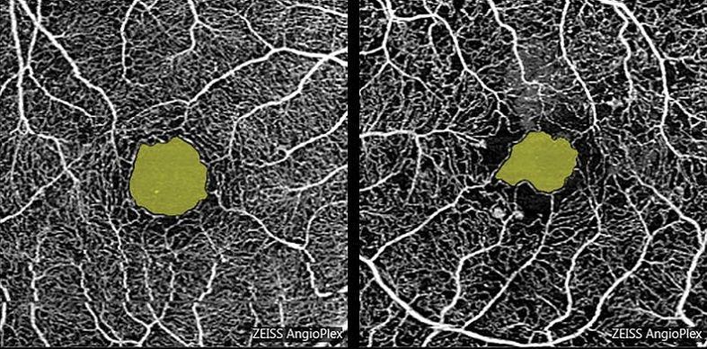 Carl Zeiss OCT AngioPlex