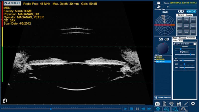 Accutome by Keeler UBM Plus