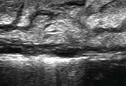 Acuvista Grace Scale