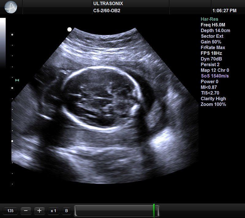UltraSonix SonixTouch