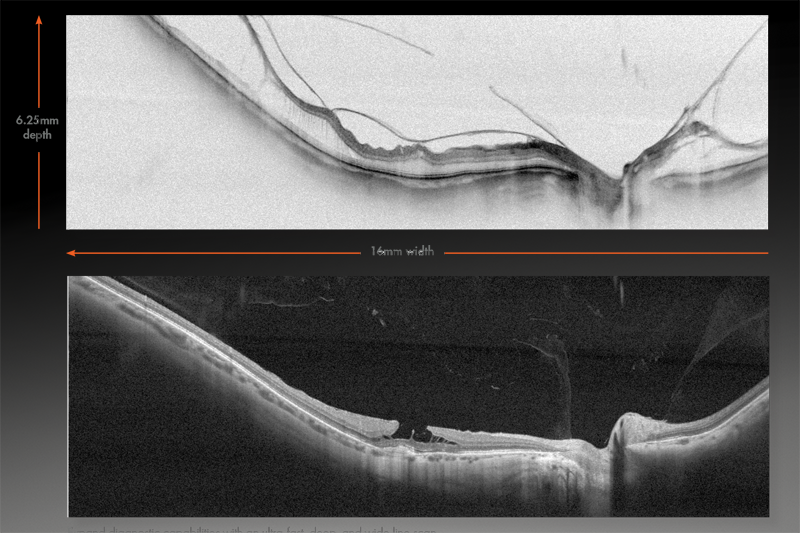 Optovue SOLIX