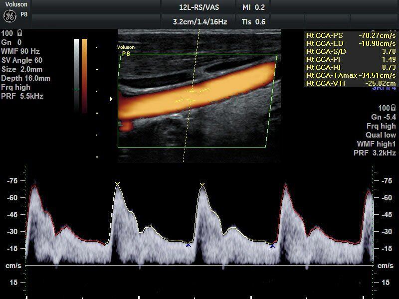 GE Healthcare Voluson P6