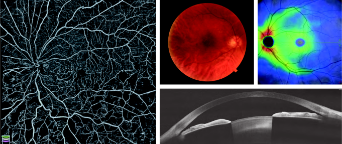 Optovue SOLIX